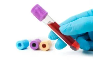 Stentare după un atac de cord Stentare după un atac de cord