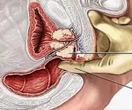 Simptomele prostatita la bărbați
