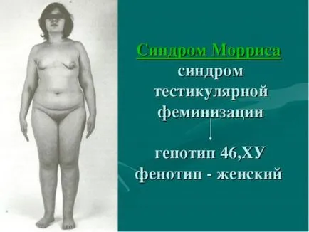 Sindromul Morris este ceea ce este
