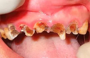 Cariile de dentinei Cariile de dentinei