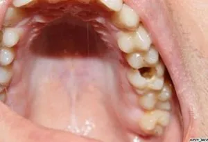 Cariile de dentinei Cariile de dentinei