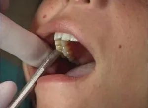 Cariile de dentinei Cariile de dentinei
