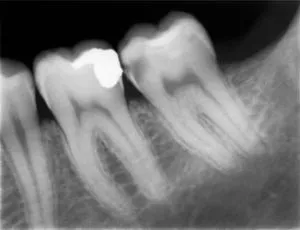 Cariile de dentinei Cariile de dentinei