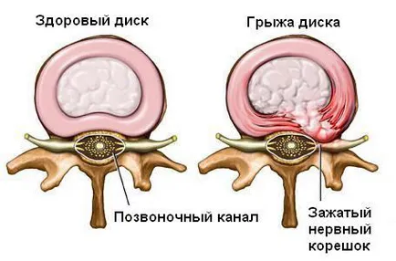 Tratament Herniile intervertebrale fără o intervenție chirurgicală
