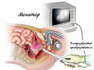 pregătire de prostată Uzi pregătire de prostată Uzi