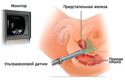pregătire de prostată Uzi