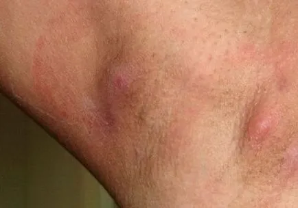 Inflamația axila, care este Inflamația axila, care este