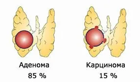 Tiroidiană adenom cauze, simptome, tratament