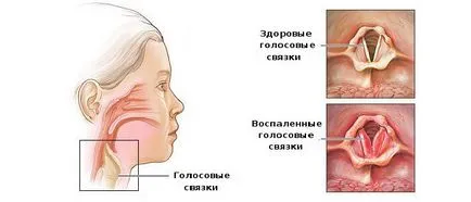infecție Antibioticele respirator superior virusul tractului (respirator) Antibiotice pentru infecții virale ale tractului respirator superior