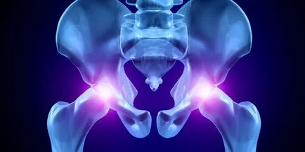Osteoartrita de sold - simptome si tratament de remedii populare, medicamente și exerciții