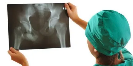 Osteoartrita de sold - simptome si tratament de remedii populare, medicamente și exerciții