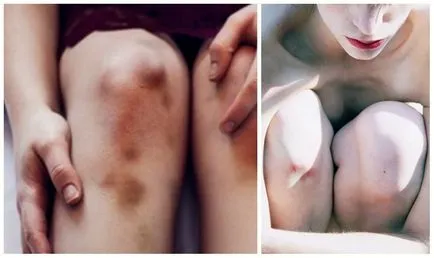 contuzii Badyaga, condițiile de utilizare a gelului și pulbere