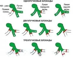 Blocada a ventriculului stâng al inimii, blocarea completă a ventriculului stâng, blocada ventriculului stâng al fasciculului (inima) Blocada a ventriculului stâng al inimii, blocarea completă a ventriculului stâng, ventriculul stâng al blocajului fasciculului