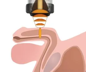 boala Peyronie la barbati cauze, simptome, diagnostic si tratament la domiciliu si chirurgie