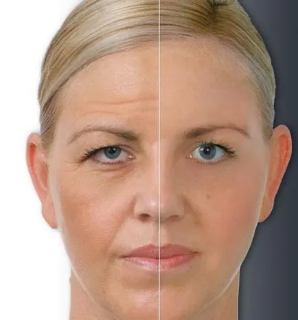 Botox - este faptul că prețul de injectiile cu Botox, comentarii