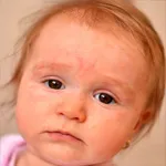 dermatita foto la copii, adulți, picioare, fata