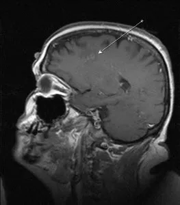 demielinizare cerebrală