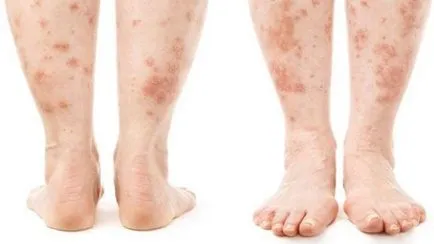 Dermatită (fotografii) - simptome și tratament la adulți