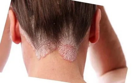 Dermatită (fotografii) - simptome și tratament la adulți