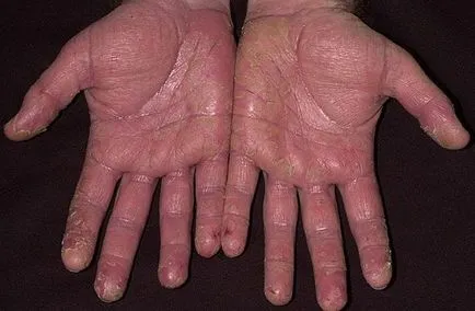 Dermatită (fotografii) - simptome și tratament la adulți
