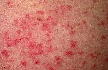 Dermatită (fotografii) - simptome și tratament la adulți