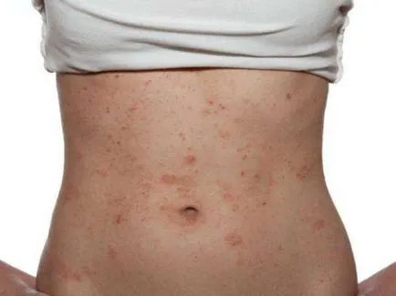 Dermatită (fotografii) - simptome și tratament la adulți