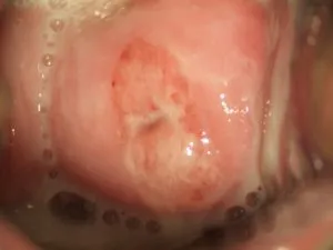 simptome de drojdie infecție, tratamentul, prevenirea