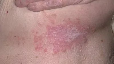 Drojdie infecție a pielii la tratamentul femeilor și a simptomelor