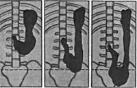 GASTROPTOSIS - cauze, simptome, diagnostic și tratament