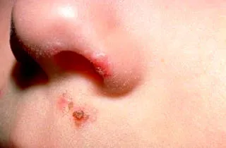 Herpes pe nas - cauzele si tratamentul rapid la domiciliu (nas) Herpes pe nas - cauze si tratament rapid la domiciliu