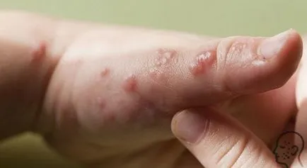 Herpes pe mâini și degete - cauze, simptome si tratament (foto)