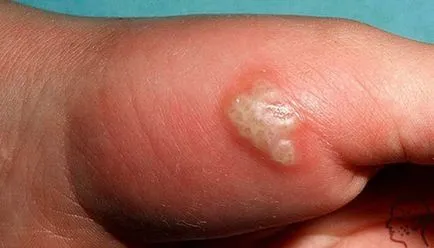 Herpes pe mâini și degete - cauze, simptome si tratament (foto)