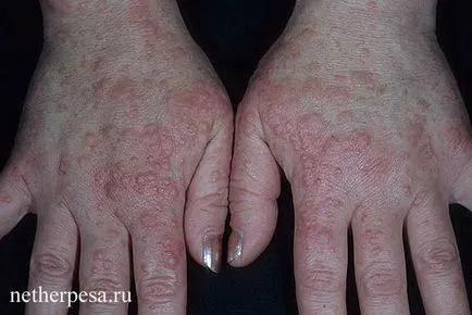 Herpes pe diagnostic mâini, simptome, tratament