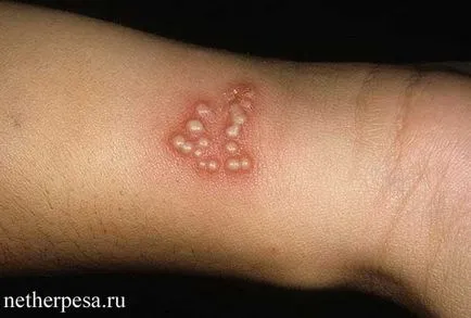 Herpes pe diagnostic mâini, simptome, tratament