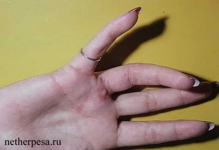 Herpes pe diagnostic mâini, simptome, tratament