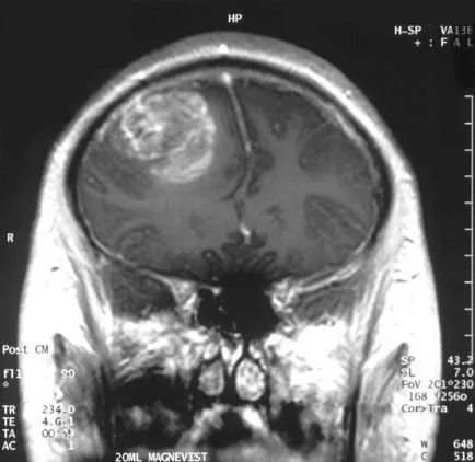 bariera hematoencefalică
