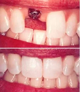 Implanturile dentare alfa bio (alfa bio), implanturi dentare bio alfa - avantaje și dezavantaje (dinți) Implanturile dentare alfa bio (alfa bio), implanturi dentare bio alfa - avantaje și dezavantaje