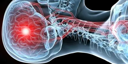 Accident vascular cerebral și consecințele sale - care sunt șansele de supraviețuire (tratament) Accident vascular cerebral și consecințele sale - care sunt șansele de supraviețuire