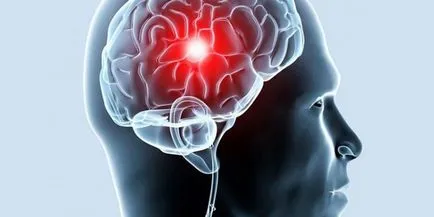 Accident vascular cerebral și consecințele sale - care sunt șansele de supraviețuire (cauza) Accident vascular cerebral și consecințele sale - care sunt șansele de supraviețuire