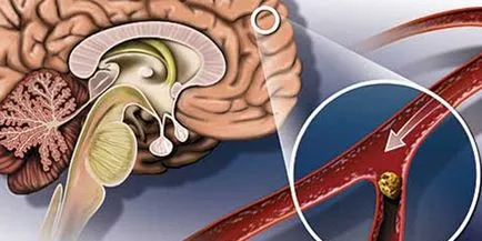 Accident vascular cerebral și consecințele sale - care sunt șansele de supraviețuire (accident vascular cerebral creier) Accident vascular cerebral și consecințele sale - care sunt șansele de supraviețuire