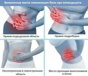 Ca simptome de durere apendicita, localizare, intensitate