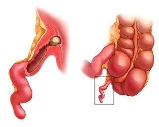 Cum inflamat unde doare apendicita apendicita, care durerea apendicita parte (durere) Cum inflamat unde doare apendicita apendicita, care durerile de partea apendicita
