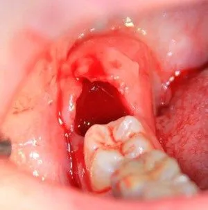 Cât timp gaura vindecă gingiile după extracția dentară, după cum se poate vindeca rana procesul de vindecare
