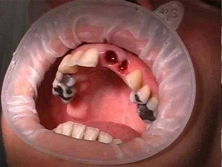 Cât timp gaura vindecă gingiile după extracția dentară, după cum se poate vindeca rana procesul de vindecare