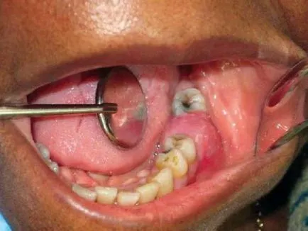 Cât timp gaura vindecă gingiile după extracția dentară, după cum se poate vindeca rana procesul de vindecare
