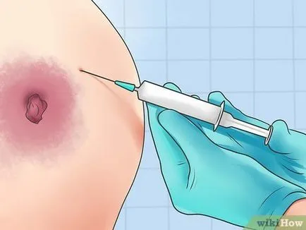 Cum de a trata un abces