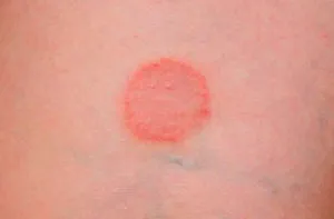 Cum începe simptome psoriazis sa recunoasca boala