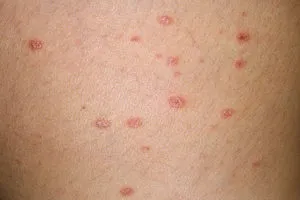 Cum începe simptome psoriazis sa recunoasca boala
