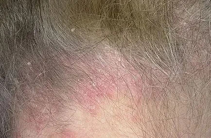 Cum începe simptome psoriazis sa recunoasca boala