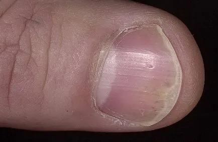 Cum începe simptome psoriazis sa recunoasca boala